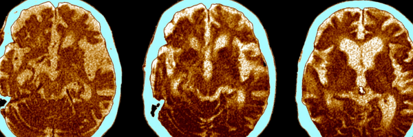 High-Resolution MicroXRF for Alzheimer’s Disease Brain Tissue Analysis